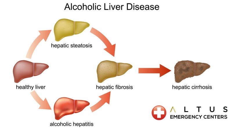 Alcohol Liver Disease phases infographic