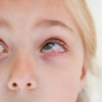 Close-up of a child's eyes showing signs of conjunctivitis or eye irritation, with redness and inflammation