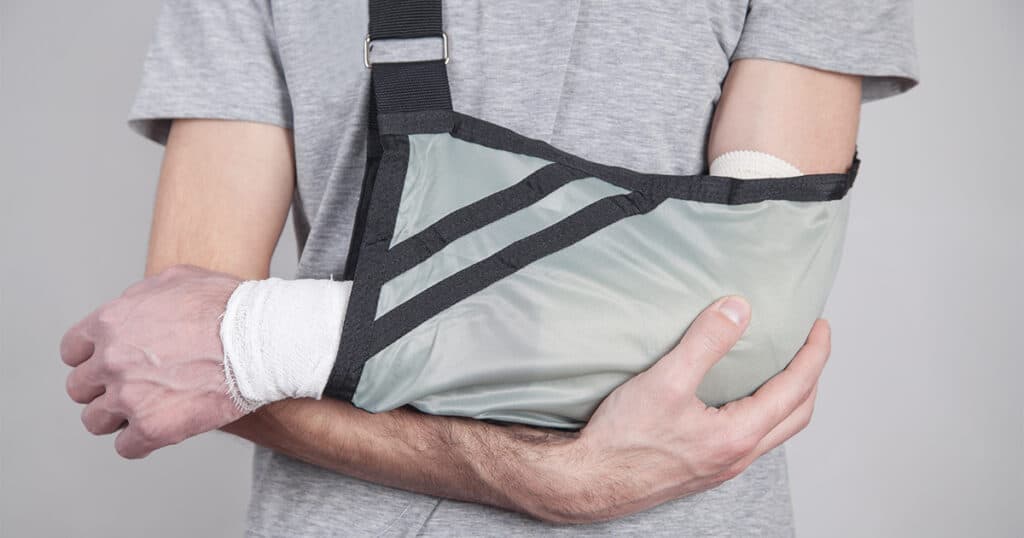A man with an arm in a sling holds a cast, indicating a hand bone fracture.