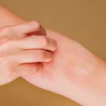 Scratching inflamed skin area showing roaming itch discomfort.